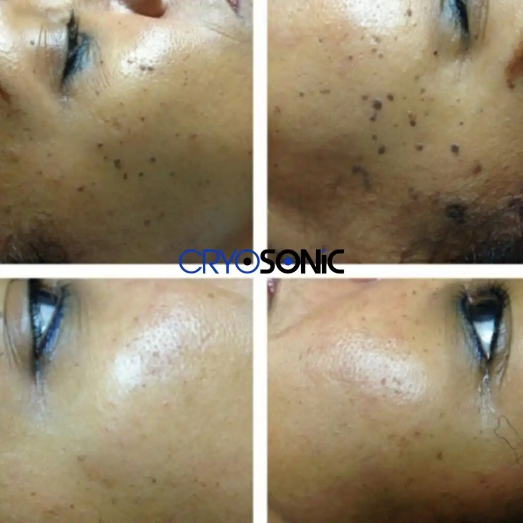 Why Skin Shows Pigmentation After Treatment Stourbridge