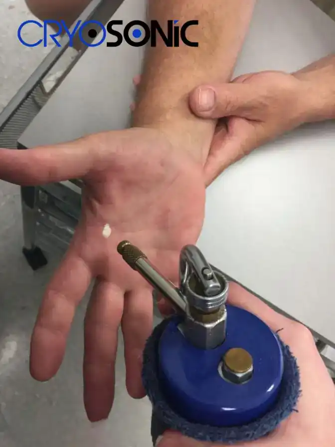 Temperature Differences: OTC vs Medical-Grade Cryotherapy Stourbridge